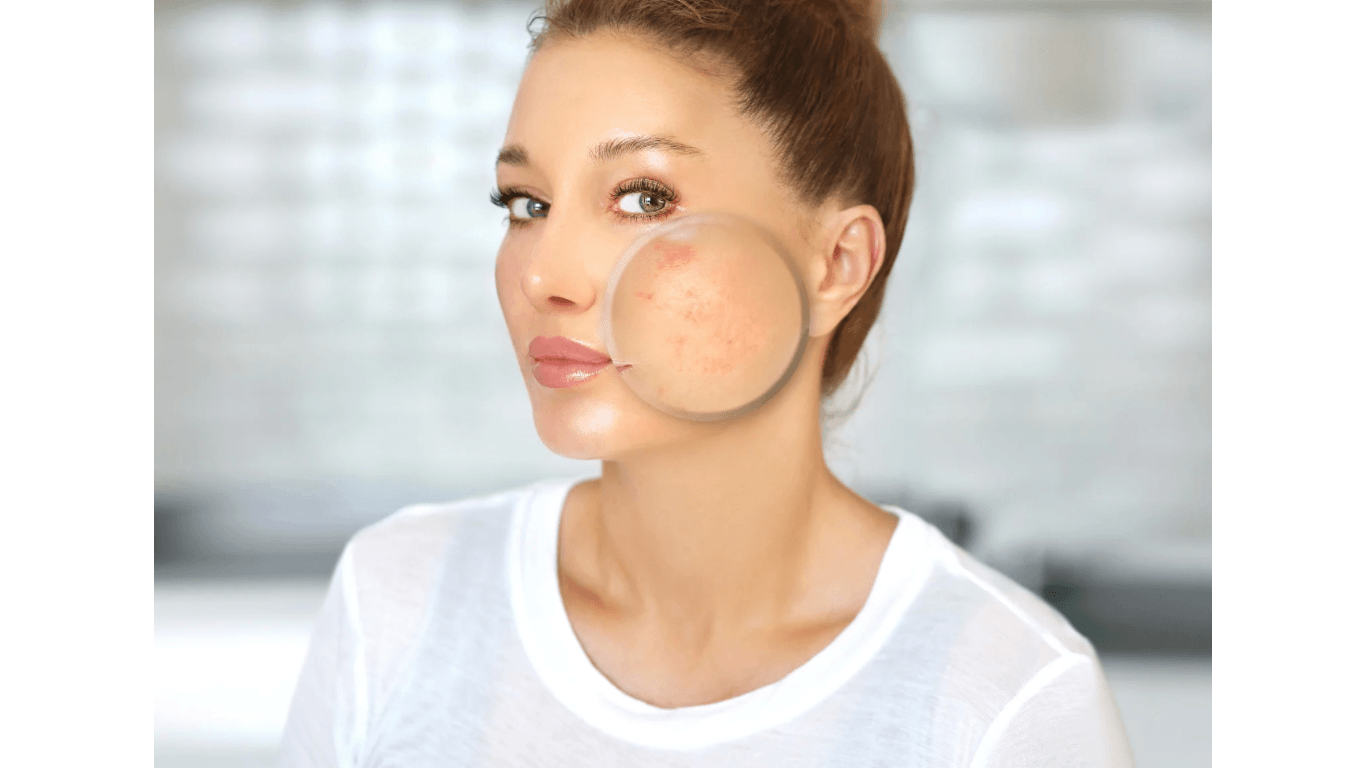 Erwachsenen-Akne – unreine Haut