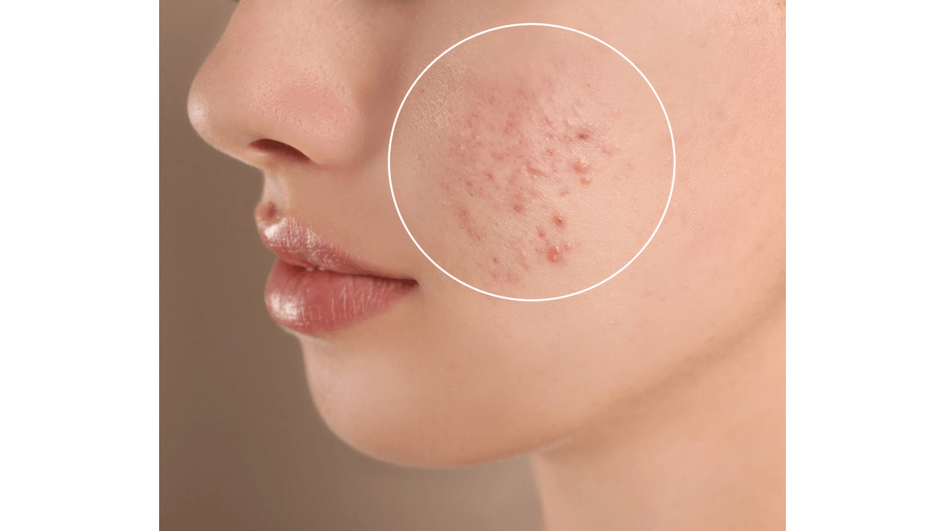 Teenager-Hautpflege Basel